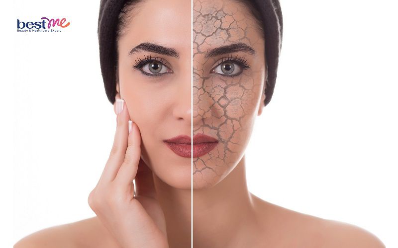 Da khô ráp cũng là một trong những nguyên nhân dị ứng da thường gặp