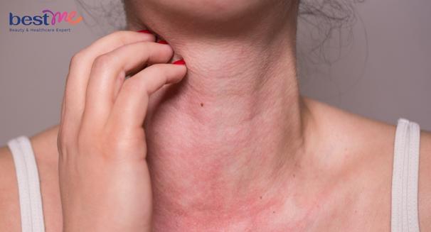 Cách khắc phục khi bị dị ứng kem chống nắng