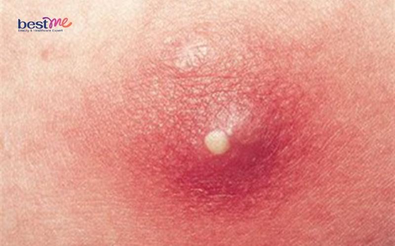 bi-mun-nhot-o-nach-bao-lau-thi-khoi-co-nguy-hiem-khong-2 Bị mụn nhọt ở nách bao lâu thì khỏi? Có nguy hiểm không? - 2