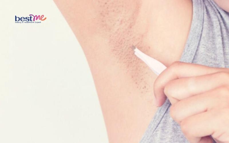 bi-mun-nhot-o-nach-bao-lau-thi-khoi-co-nguy-hiem-khong-5 Bị mụn nhọt ở nách bao lâu thì khỏi? Có nguy hiểm không? - 5
