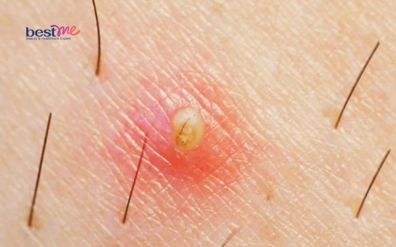 bi-mun-nhot-o-nach-bao-lau-thi-khoi-co-nguy-hiem-khong-6 Bị mụn nhọt ở nách bao lâu thì khỏi? Có nguy hiểm không? - 6