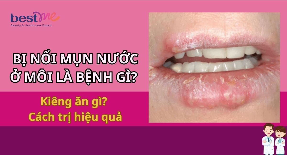 Tại sao bị nổi mụn nước ở môi? Cách trị thế nào? Kiêng ăn gì?