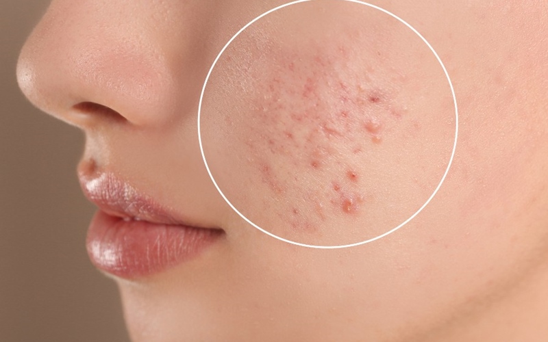 Mụn trứng cá là một vấn đề da liễu phổ biến trên toàn thế giới