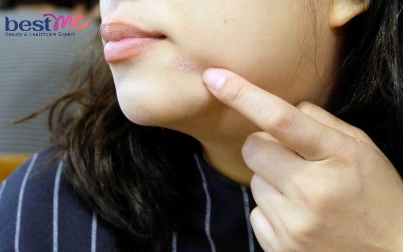 Nấm trên mặt có thể bị gây ra bởi nhiều nguyên nhân khác nhau