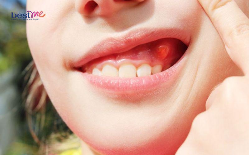 bi-noi-mun-thit-trong-mieng-la-benh-gi-co-nguy-hiem-khong-1 Bị nổi mụn thịt trong miệng là bệnh gì? Có nguy hiểm không? - 1
