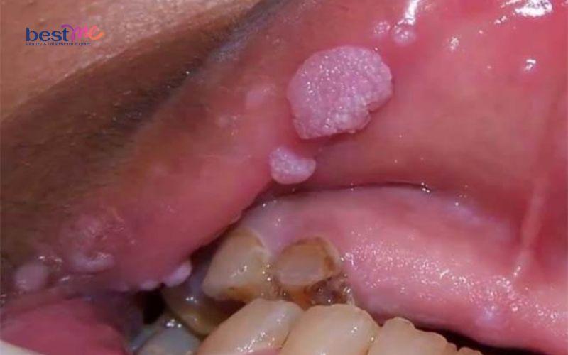 bi-noi-mun-thit-trong-mieng-la-benh-gi-co-nguy-hiem-khong-2 Bị nổi mụn thịt trong miệng là bệnh gì? Có nguy hiểm không? - 2