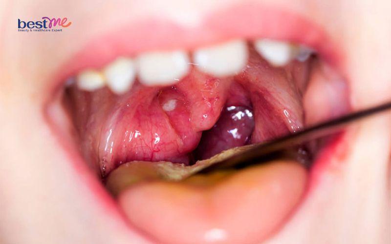 bi-noi-mun-thit-trong-mieng-la-benh-gi-co-nguy-hiem-khong-3 Bị nổi mụn thịt trong miệng là bệnh gì? Có nguy hiểm không? - 3