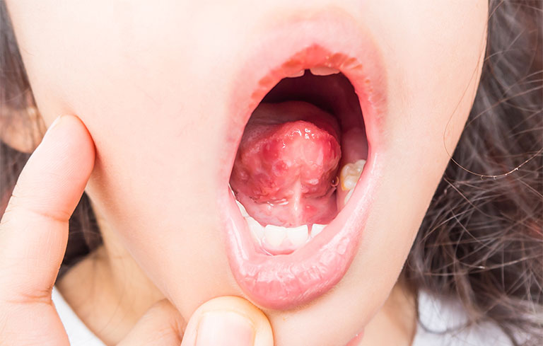 bi-noi-mun-thit-trong-mieng-la-benh-gi-co-nguy-hiem-khong-4 Bị nổi mụn thịt trong miệng là bệnh gì? Có nguy hiểm không? - 4