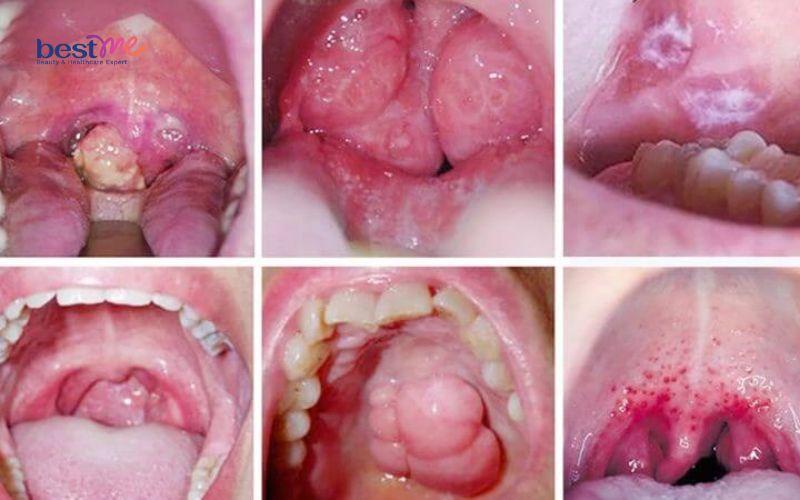 bi-noi-mun-thit-trong-mieng-la-benh-gi-co-nguy-hiem-khong-6 Bị nổi mụn thịt trong miệng là bệnh gì? Có nguy hiểm không? - 6