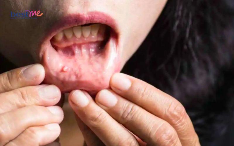 bi-noi-mun-thit-trong-mieng-la-benh-gi-co-nguy-hiem-khong-7 Bị nổi mụn thịt trong miệng là bệnh gì? Có nguy hiểm không? - 7