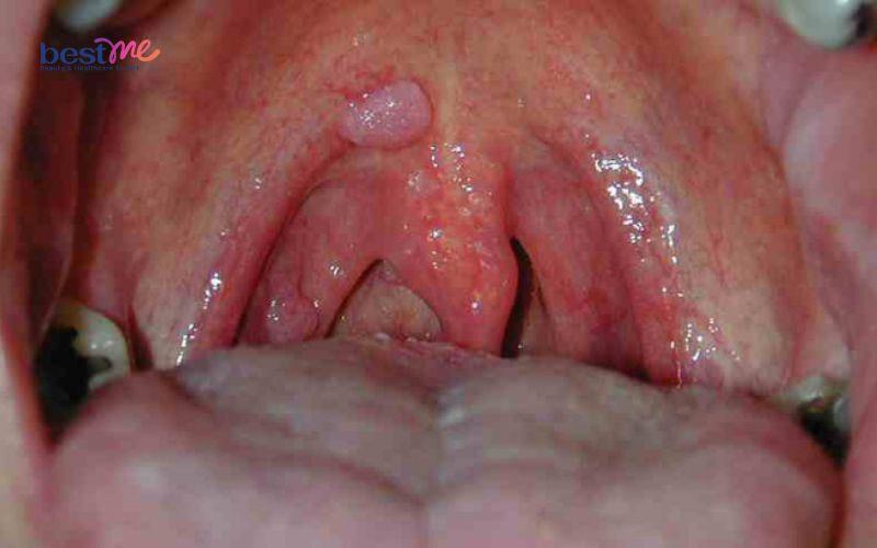 bi-noi-mun-thit-trong-mieng-la-benh-gi-co-nguy-hiem-khong-8 Bị nổi mụn thịt trong miệng là bệnh gì? Có nguy hiểm không? - 8