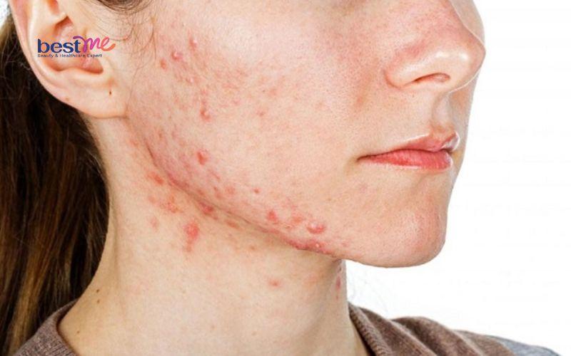 bi-quyet-dieu-tri-phat-ban-mun-trung-ca-hieu-qua-nhanh-nhat-1 Bí quyết điều trị phát ban mụn trứng cá hiệu quả nhanh nhất - 1
