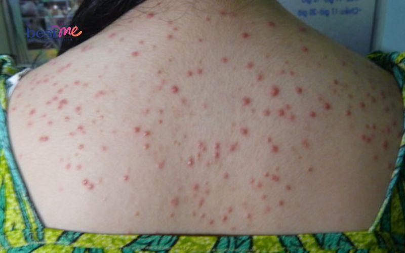 bi-quyet-dieu-tri-phat-ban-mun-trung-ca-hieu-qua-nhanh-nhat-2 Bí quyết điều trị phát ban mụn trứng cá hiệu quả nhanh nhất - 2