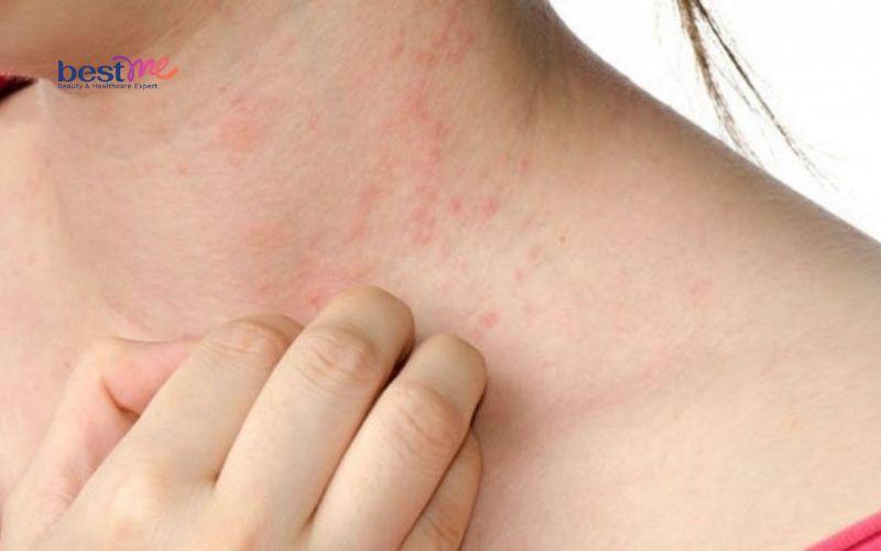 bi-quyet-dieu-tri-phat-ban-mun-trung-ca-hieu-qua-nhanh-nhat-4 Bí quyết điều trị phát ban mụn trứng cá hiệu quả nhanh nhất - 4