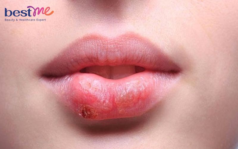 Bị tiểu đường có xăm môi được không? Các đối tượng không nên phun xăm thẩm mỹ - 2