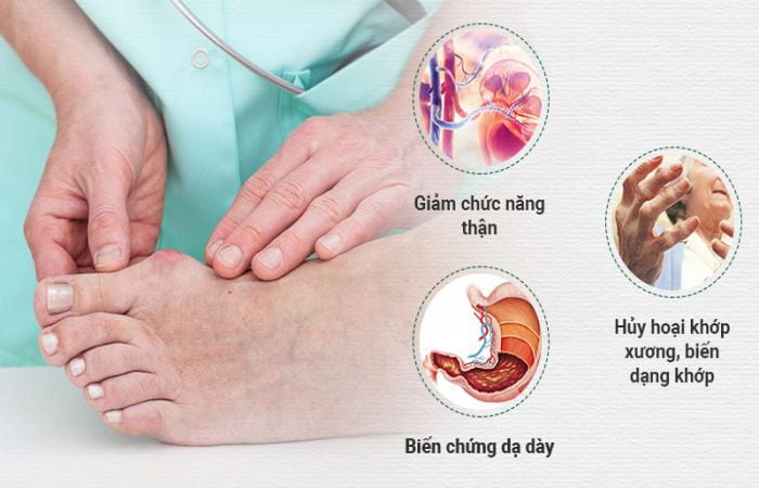 Các biến chứng nguy hiểm của bệnh gout