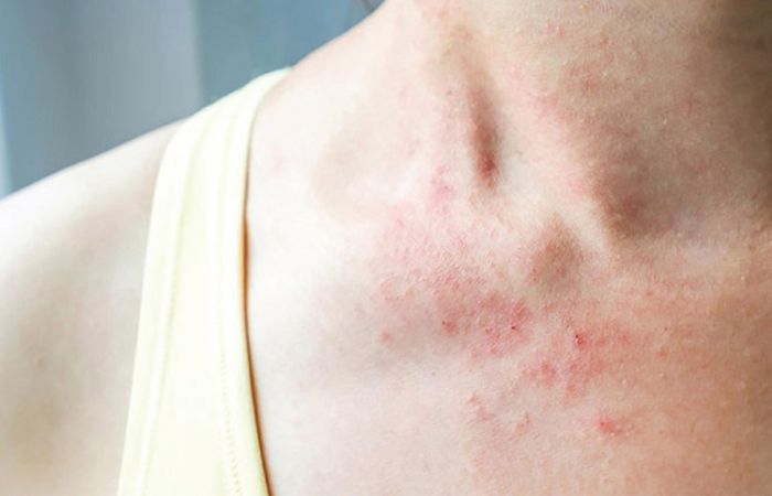 Tình trạng da bị viêm da tiếp xúc