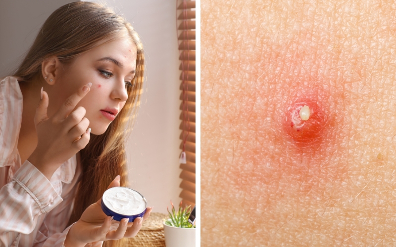 boi-kem-tri-mun-bao-lau-thi-rua-mat-la-tot-va-hieu-qua-nhat-1 Bôi kem trị mụn bao lâu thì rửa mặt là tốt và hiệu quả nhất? - 1