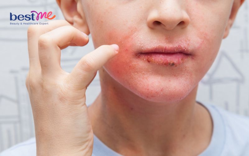 Bị bỏng da mặt nên làm gì?