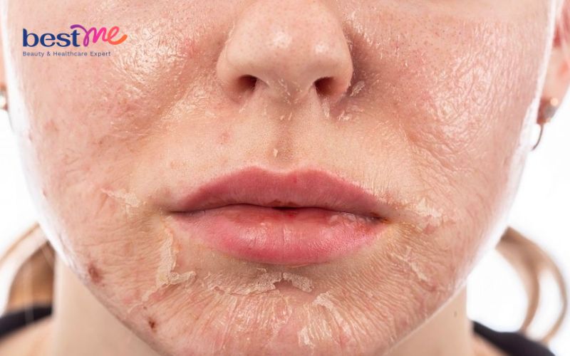 Bị bỏng da mặt do mỹ phẩm