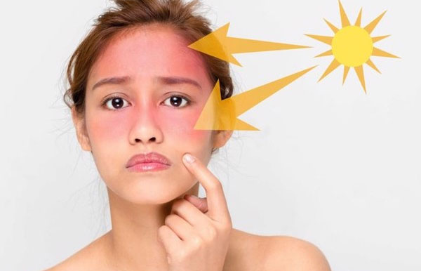 Các bước sơ cứu làn da cháy nắng