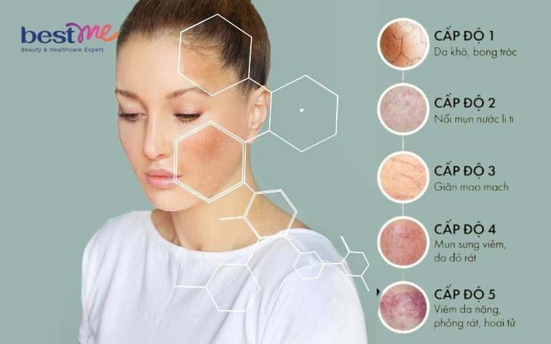 Các cấp độ da nhiễm corticoid