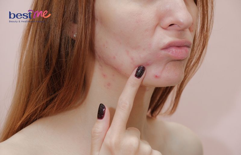 Da dầu mụn là loại da dầu (da nhờn) và có mụn