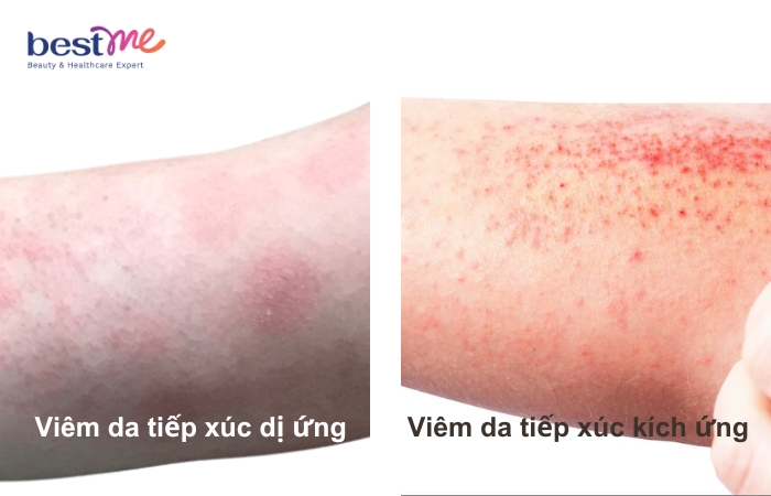 Hai loại dị ứng kem chống nắng phổ biến