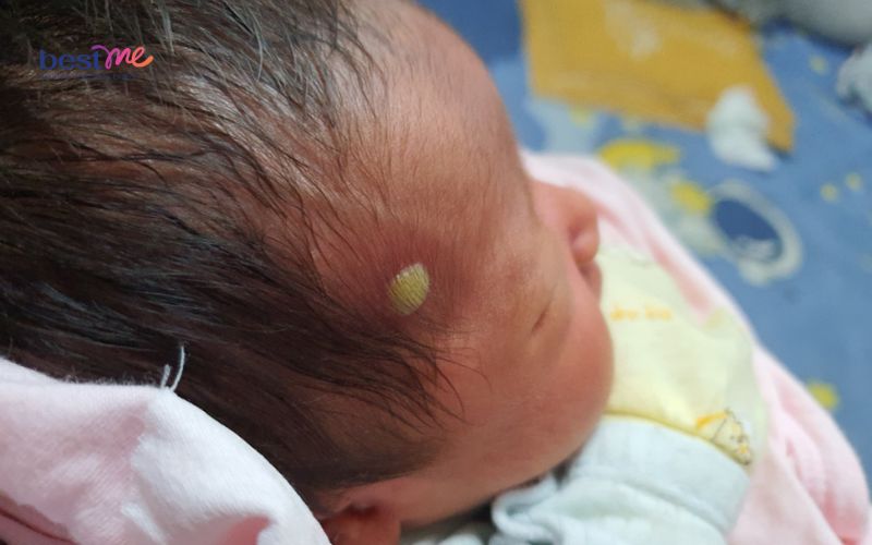 Các loại mụn ở trẻ sơ sinh thường gặp nhất và cách xử lý - 1