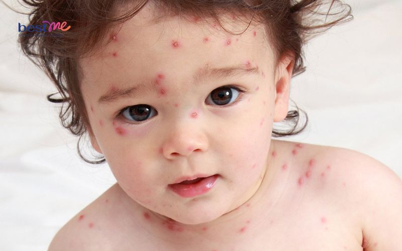 Các loại mụn ở trẻ sơ sinh thường gặp nhất và cách xử lý - 10