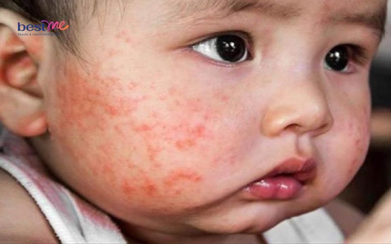 Các loại mụn ở trẻ sơ sinh thường gặp nhất và cách xử lý - 3