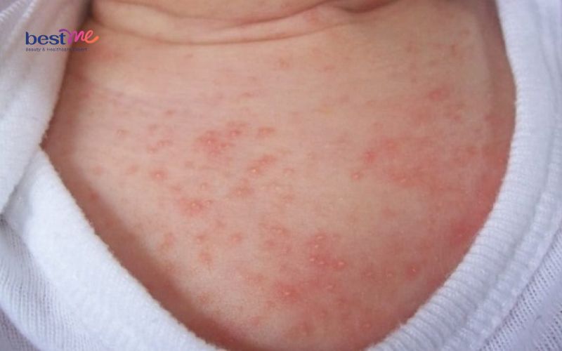 Các loại mụn ở trẻ sơ sinh thường gặp nhất và cách xử lý - 5