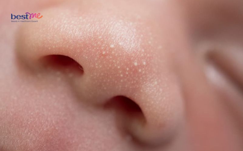 Các loại mụn ở trẻ sơ sinh thường gặp nhất và cách xử lý - 6