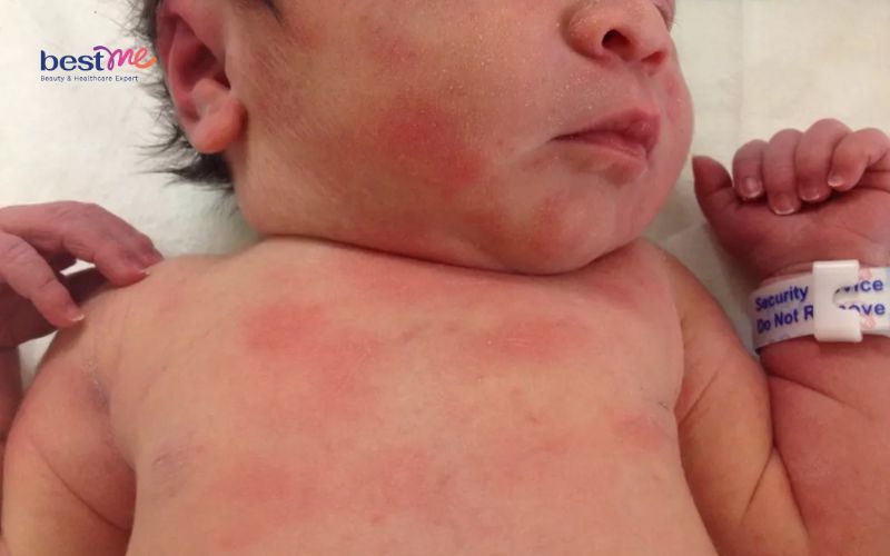 Các loại mụn ở trẻ sơ sinh thường gặp nhất và cách xử lý - 8