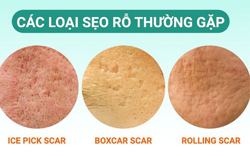 Nguyên nhân và phương pháp phục hồi da mặt bị rỗ tại nhà an toàn - 2