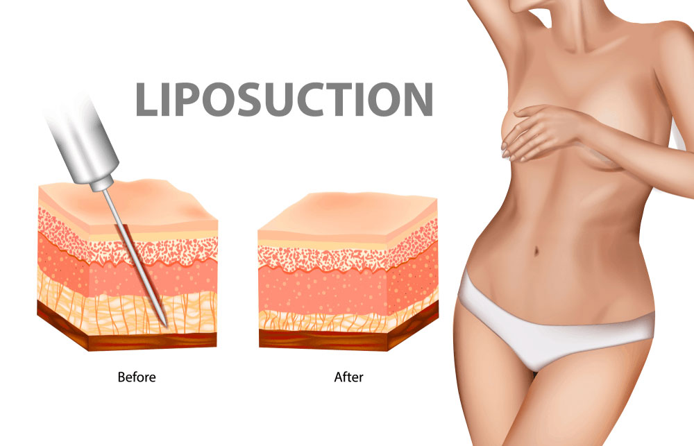 Phương pháp hút mỡ bụng liposuction