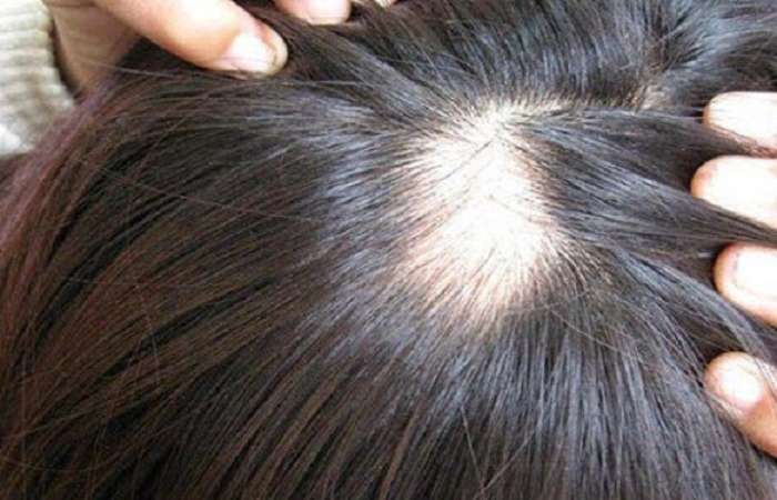 Khi chọn dầu gội trị rụng tóc, bạn nên ưu tiên sản phẩm chứa các dưỡng chất và khoáng chất giúp kiềm dầu cho da đầu.