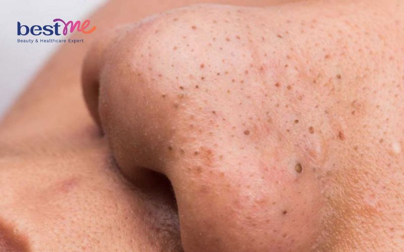 cach-dung-bha-tri-mun-dau-den-va-cac-san-pham-hieu-qua-nhat-4 Cách dùng BHA trị mụn đầu đen và các sản phẩm hiệu quả nhất - 4