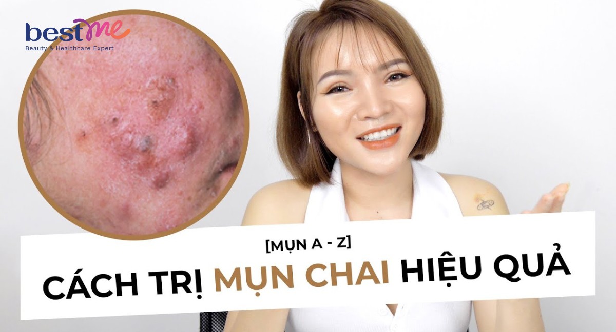 Mụn bọc bị chai là gì? Cách nặn mụn bọc bị chai cứng an toàn