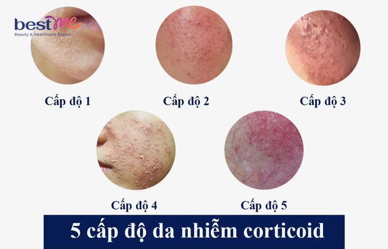 Hình ảnh da nhiễm corticoid theo từng giai đoạn