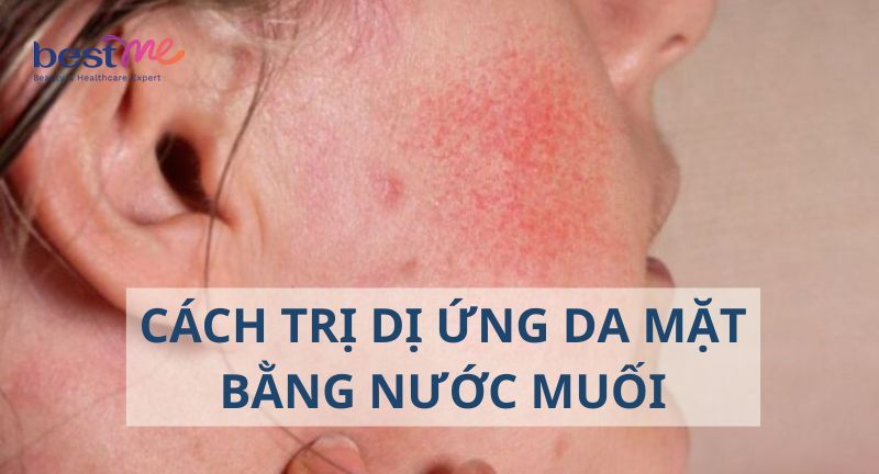 2 cách trị dị ứng da mặt bằng nước muối chuẩn chuyên gia