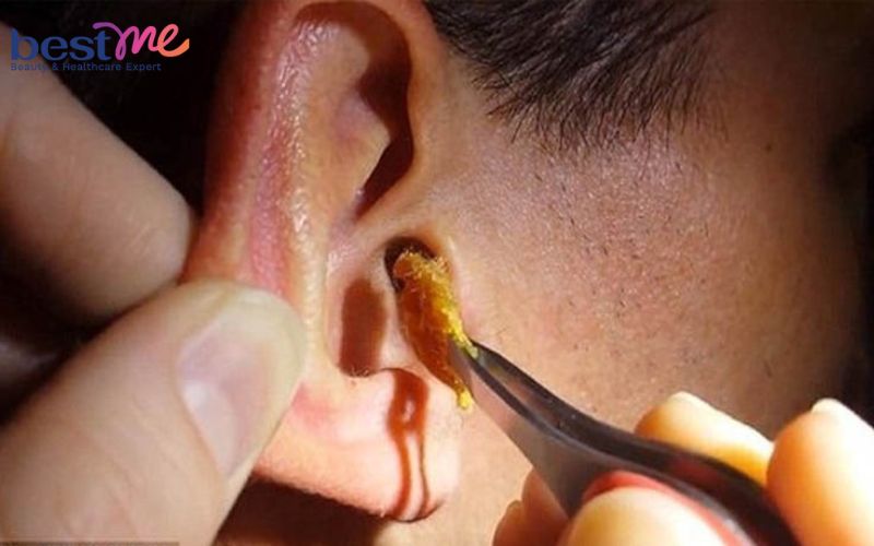 cach-tri-mun-nhot-o-tai-trong-lo-tai-an-toan-hieu-qua-nhat-2 Cách trị mụn nhọt ở tai, trong lỗ tai an toàn hiệu quả nhất - 2