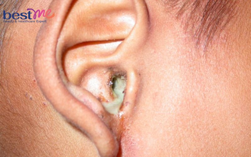 cach-tri-mun-nhot-o-tai-trong-lo-tai-an-toan-hieu-qua-nhat-3 Cách trị mụn nhọt ở tai, trong lỗ tai an toàn hiệu quả nhất - 3