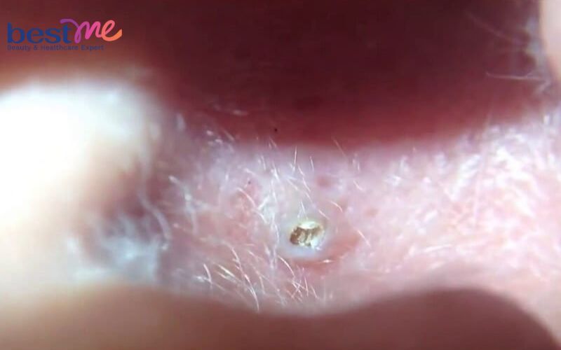 cach-tri-mun-nhot-o-tai-trong-lo-tai-an-toan-hieu-qua-nhat-5 Cách trị mụn nhọt ở tai, trong lỗ tai an toàn hiệu quả nhất - 5