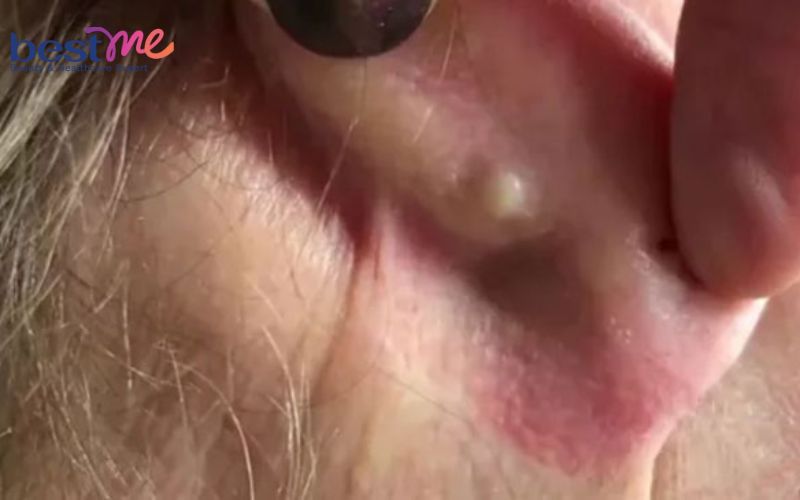 cach-tri-mun-nhot-o-tai-trong-lo-tai-an-toan-hieu-qua-nhat-6 Cách trị mụn nhọt ở tai, trong lỗ tai an toàn hiệu quả nhất - 6