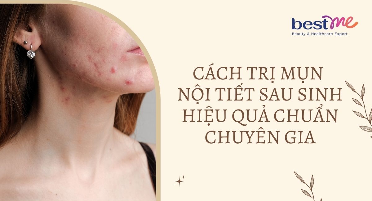 Cách trị mụn nội tiết sau sinh hiệu quả chuẩn chuyên gia