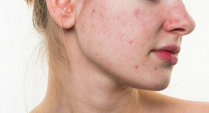 Cách trị nóng gan nổi mụn ngứa bằng chế độ ăn uống