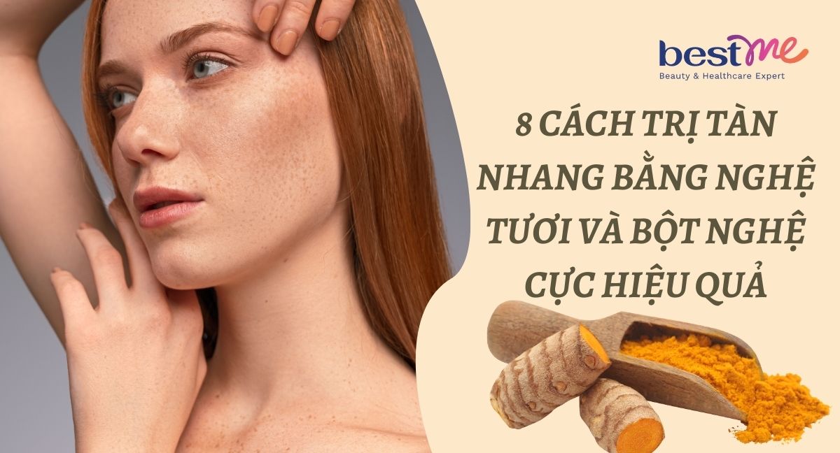 8 cách trị tàn nhang bằng nghệ tươi và bột nghệ cực hiệu quả