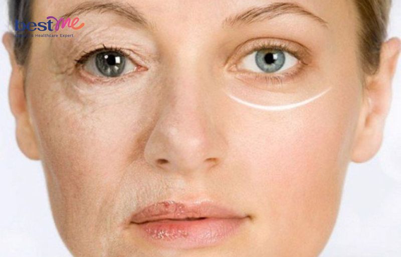 Peel da giúp cải thiện nếp nhăn