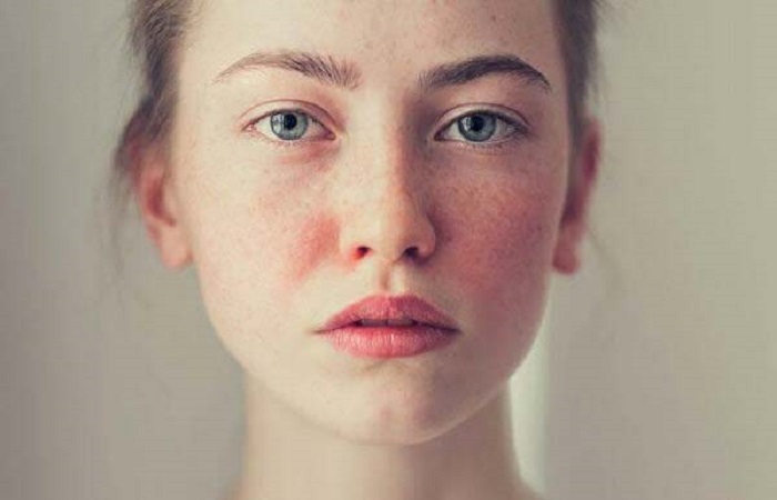 Các vết nám, tàn nhang hiện rõ lên da khi bị dị ứng mỹ phẩm nặng